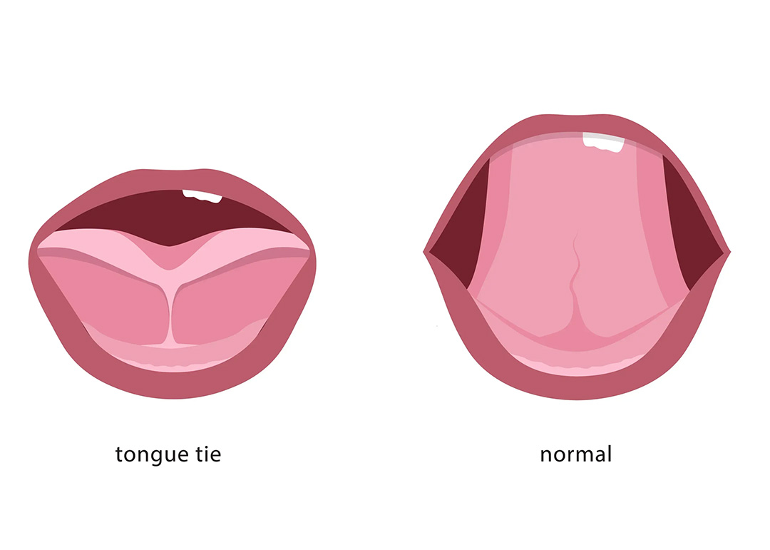Tongue Tie Release Dentists Near Me