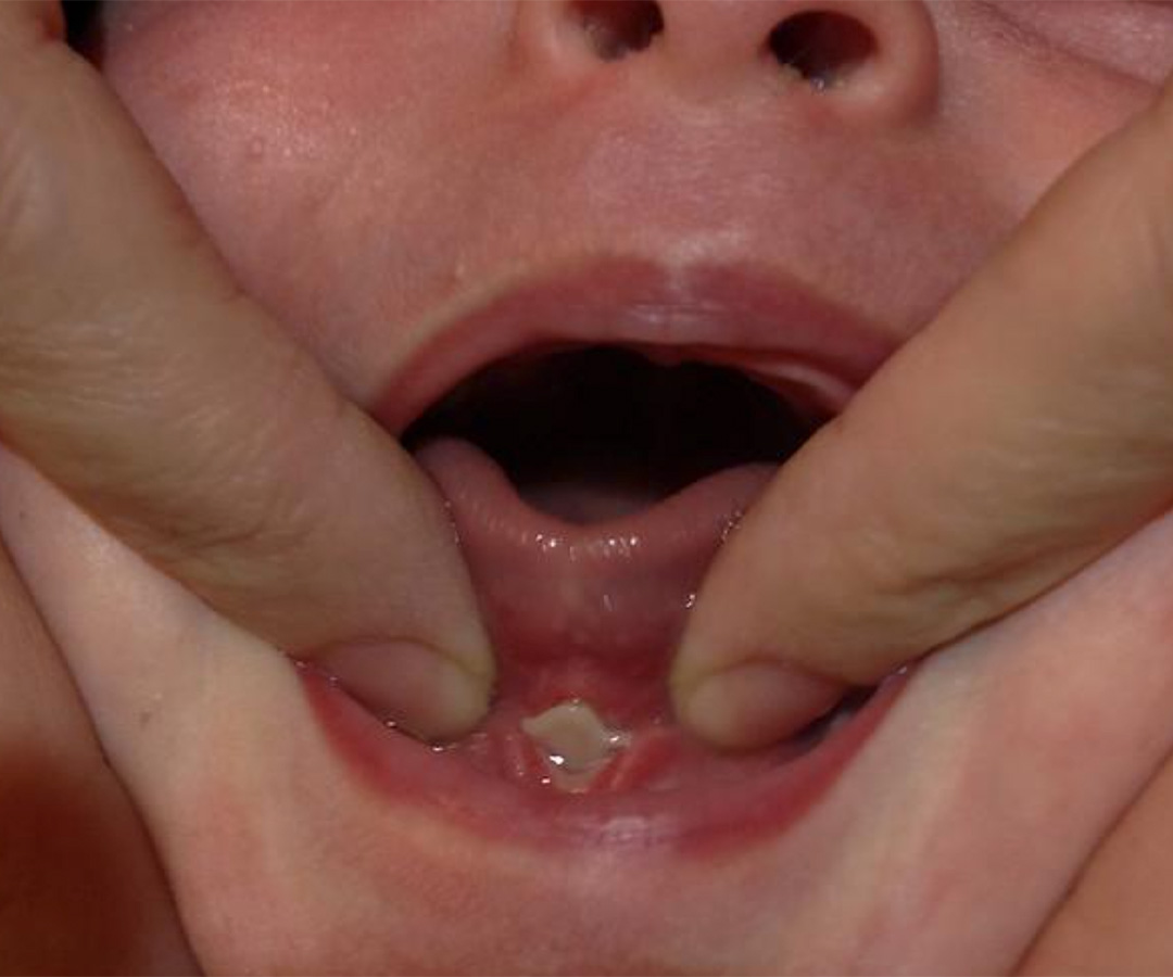 Michigan Tongue Tie Airway Center Oral Wounds